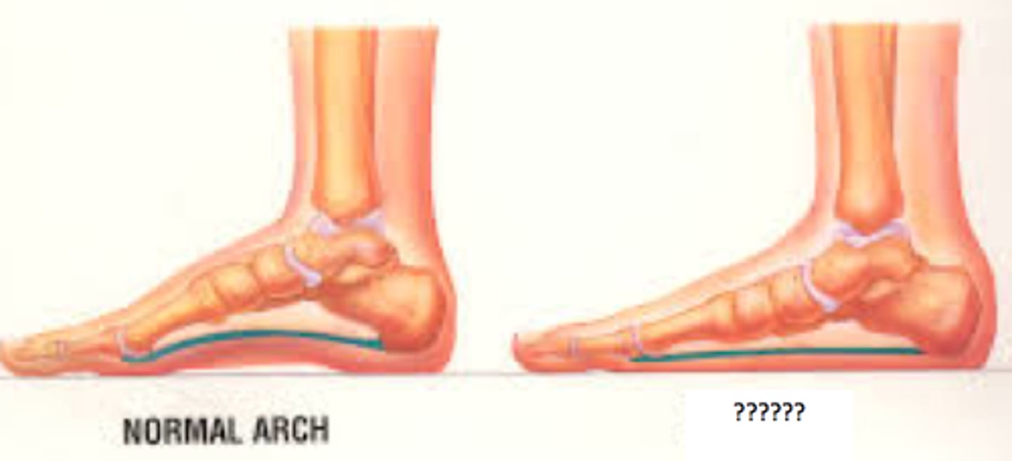 <p>Can be flexible (common in children) or rigid (pathologic in adults)</p><p>"flat foot"</p>
