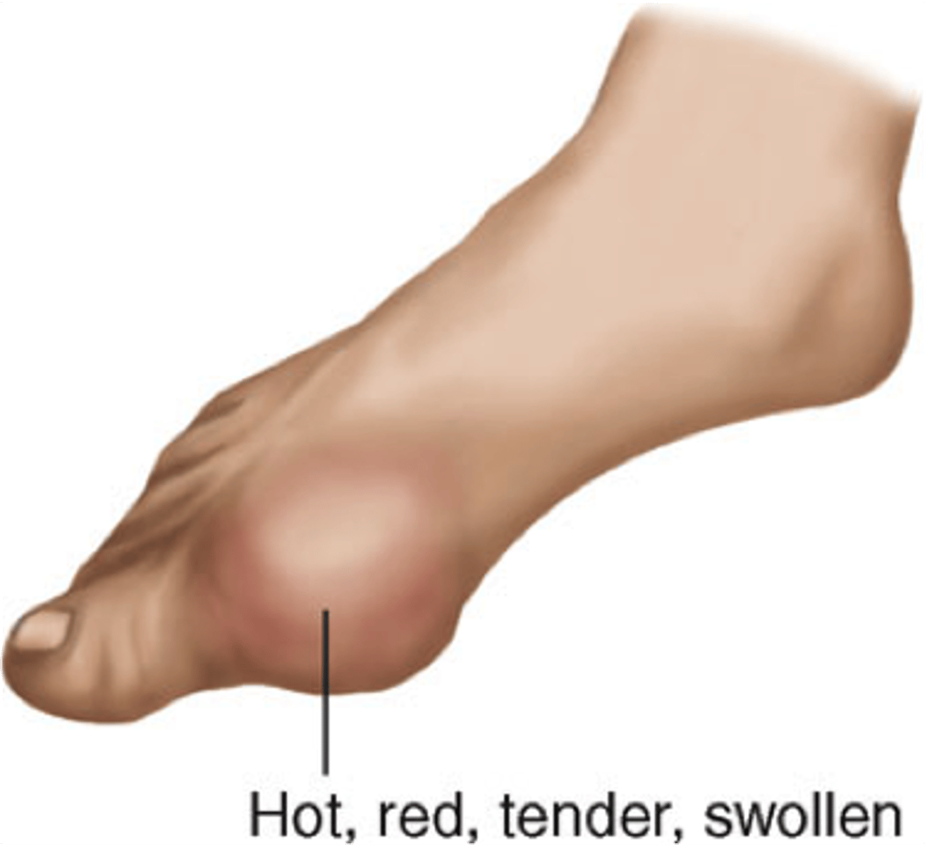 <p>inflammation and painful swelling of joints caused by excessive uric acid in the body</p><p>found in great toe</p><p>painful red hot and swollen</p>