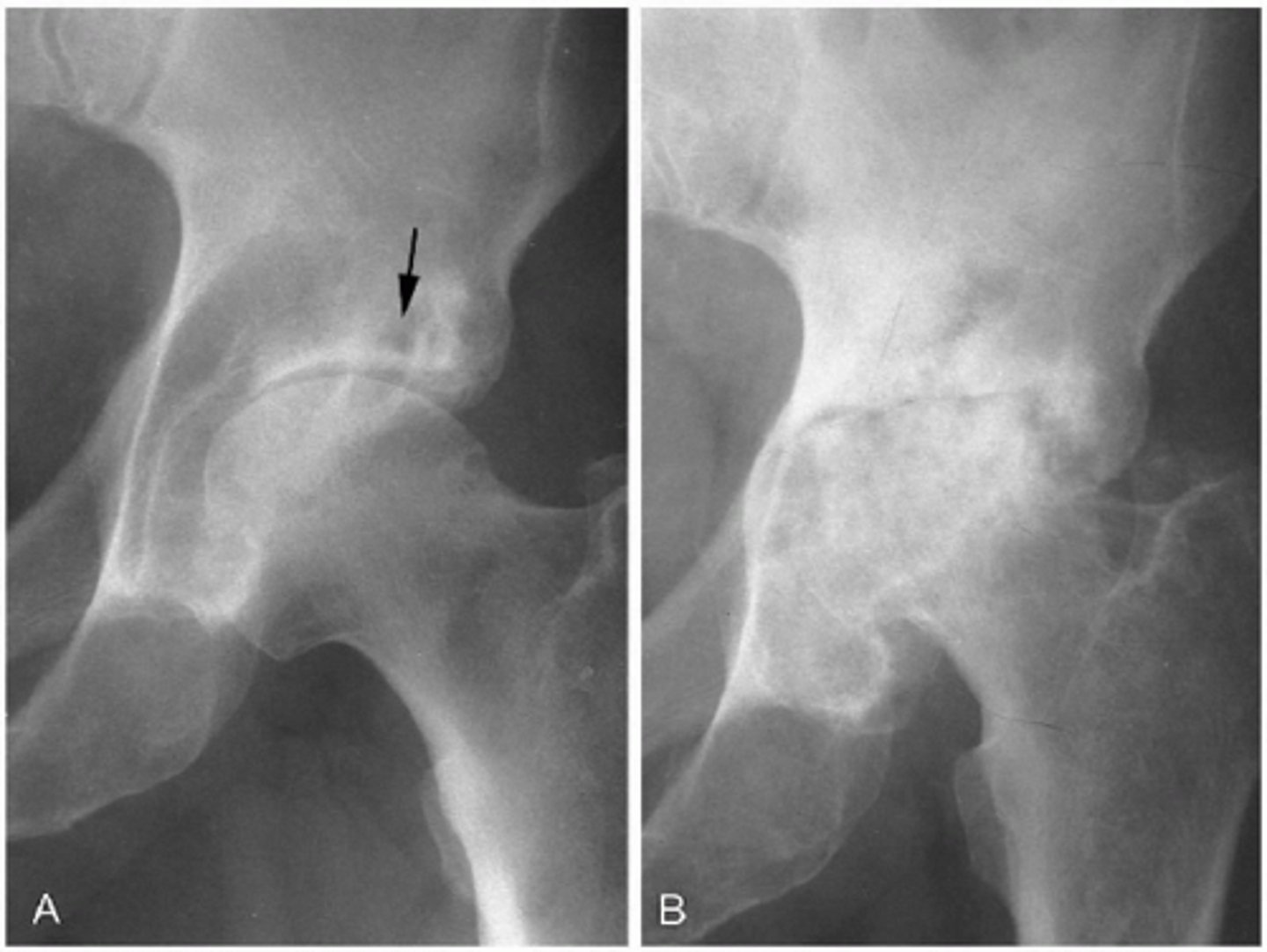 <p>- femoral neck fractures increase risk<br>- preserved joint space<br>- MRI detects changes in bone marrow, bone tumors, stress fx and AVN<br>- CRESCENT SIGN</p>