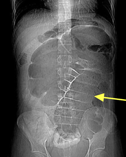 <p>section of twisted bowel causing obstruction and strangulation</p><p><em>Abdominal Radiograph</em></p>