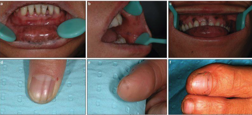 <ol><li><p>macules of the labial and/or buccal mucosa</p></li><li><p>longitudinal streaks in fingernails (melanonychia</p></li></ol><p></p>