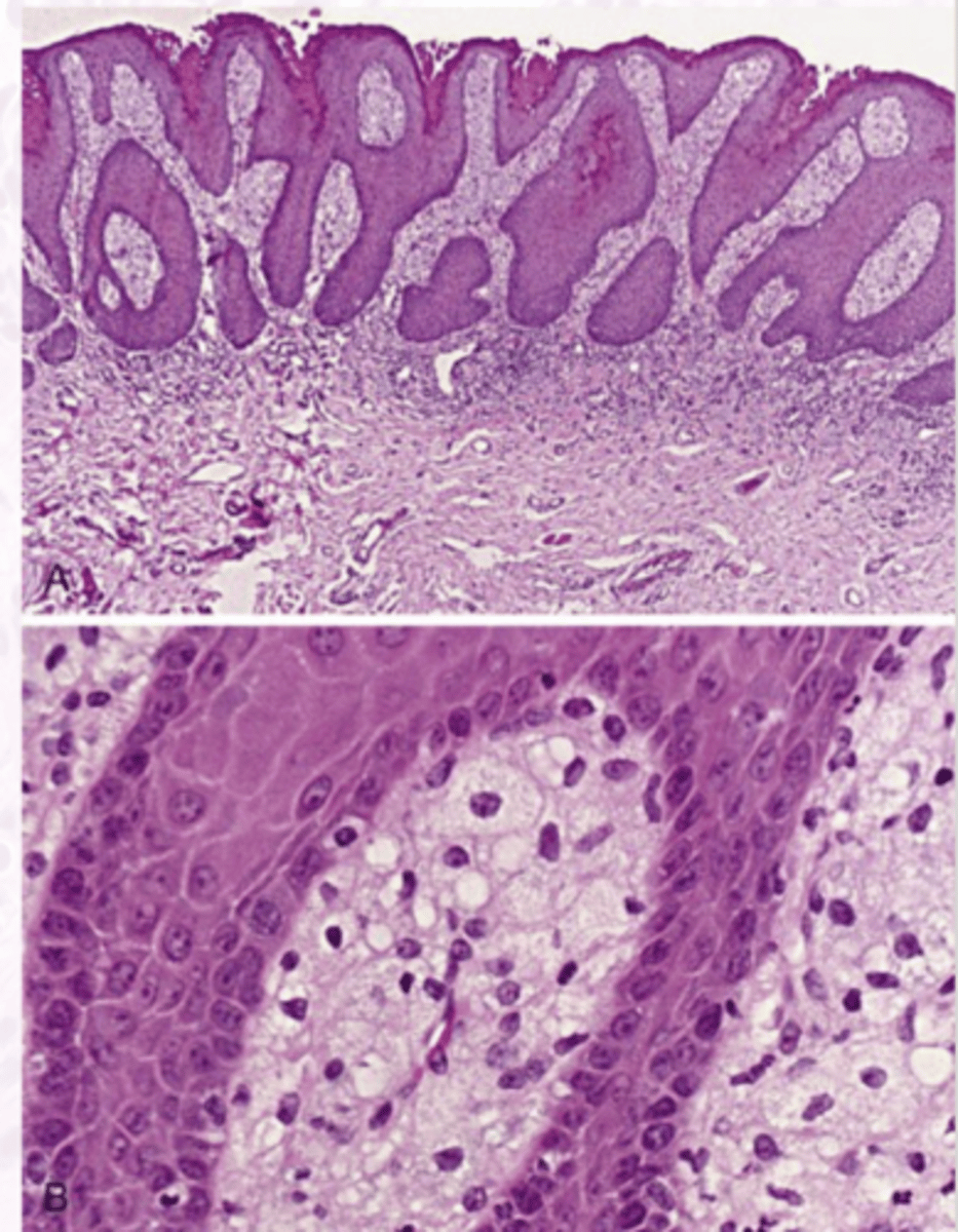 <p>Verruciform xanthoma histology</p>