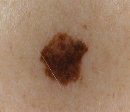 <p>is this a macule, papule, nodule, or lobule </p>