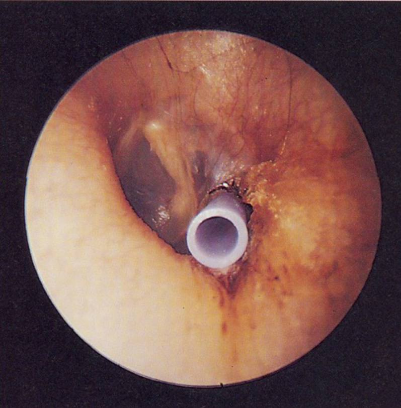 <p><u>normal otoscopy</u></p><p>what type of tube is this</p>