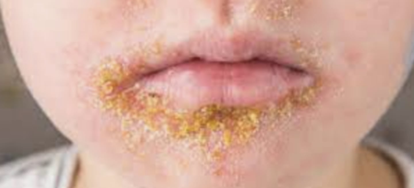 <p>PE: </p><p>Erosions w/ honey-colored crusts and surrounding erythema </p>