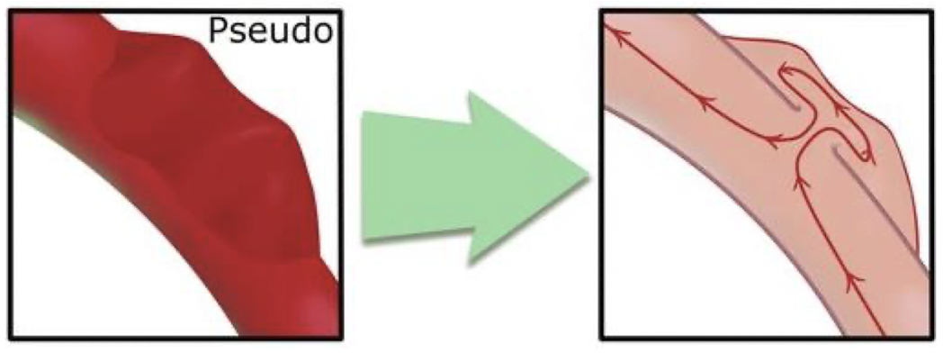 <p>not lined by all 3 AO layers; blood is escaping from hole in intima layer —> outpouch and pseudo (“fake”) aneurysm</p>