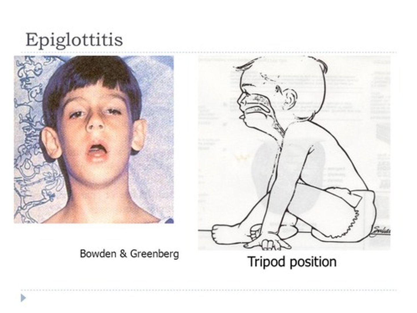 <p>An upright position in which the patient leans forward onto two arms stretched forward and thrusts the head and chin forward; suggests epiglottitis </p>