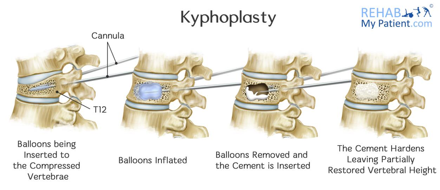 <p>minimally invasive surgical procedure to treat compression fractures of the spine, particularly those caused by osteoporosis or other conditions leading to bone weakness</p>