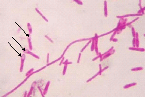 <p><strong>Purple rods (Gram-positive bacillus, spore-forming).</strong></p><p>Type: Bacteria (anaerobic, spore-forming);</p><p>Disease: Botulism (flaccid paralysis → can't move muscles);</p><p>Diagnosis: Symptoms (blurred vision, weakness), toxin tests;</p><p>Treatment/Prevention: Antitoxin + supportive care; avoid giving honey to infants; proper food canning; </p><p>Spread/Unique: Produces botulinum toxin, the most powerful natural toxin — <strong>blocks nerve signals.</strong></p>