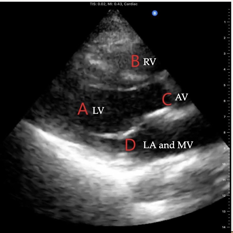 <p>Parasternal long axis (PLAX)</p>