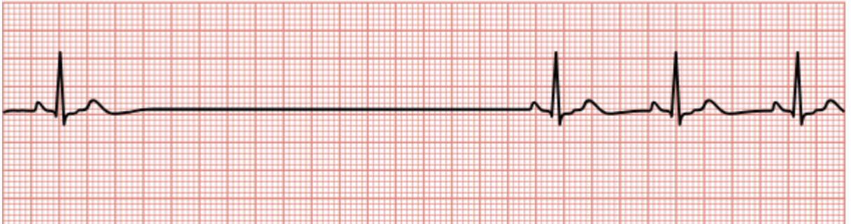 <p>SA node fails to fire, causing a break in the normal EKG.</p>