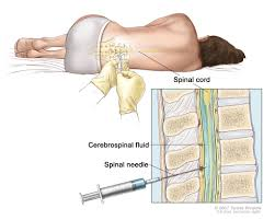<p>list the sequence of the above test in the proper order) spinal tap picture</p><p>A- arachnoid mater</p><p>B- dermis</p><p>C- dura mater</p><p>D- epidermis</p><p>E- epidural space</p><p>F- hypodermis</p><p>G- subarachnoid space</p><p>H-msubdural space</p>