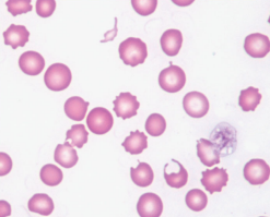 <p>Schizo = cut</p><p>“any shaped” irregular small piece of RBC</p><p></p><p>Same conditions as keratocytes</p><p>DIC</p><p>Haemangiosarcoma</p><p>Endocarditis</p><p>Caval syndrome</p>