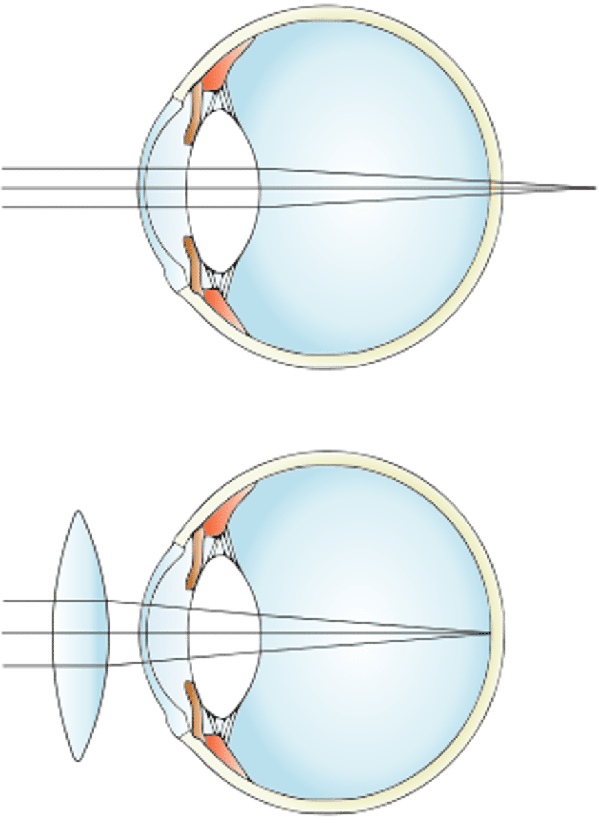<p>A convex lens (or converging lens)</p>