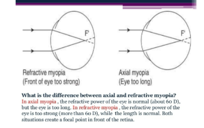 <p>refractive vs axial </p>