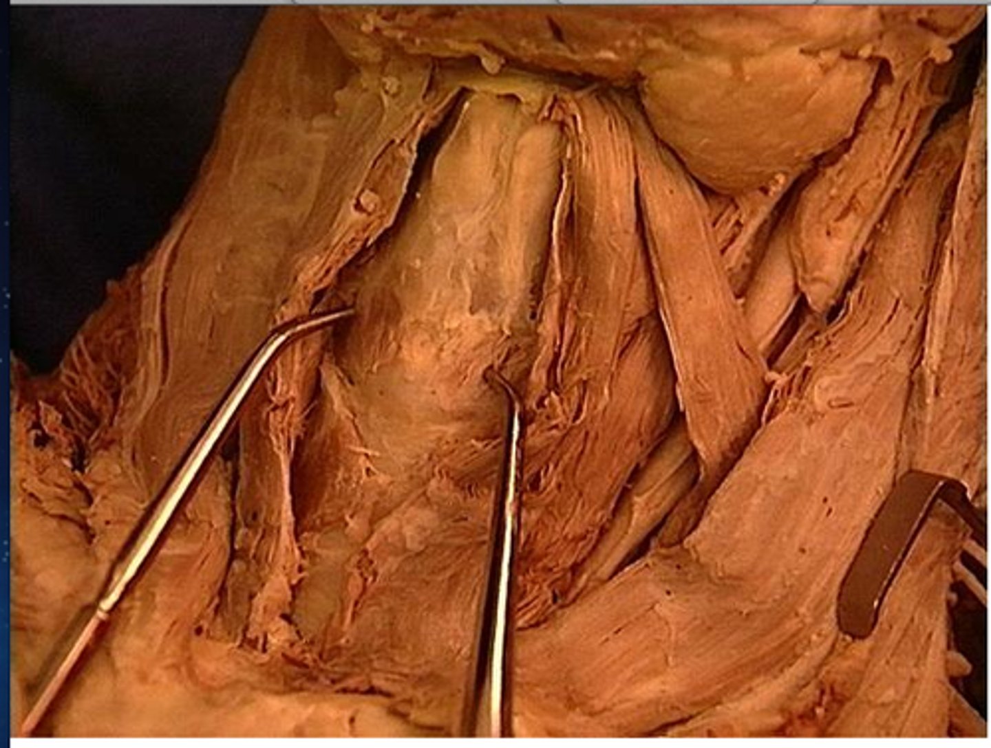 <p>A thin sheet of fascia that connects the thyroid and cricoid cartilages that make up the larynx.</p>