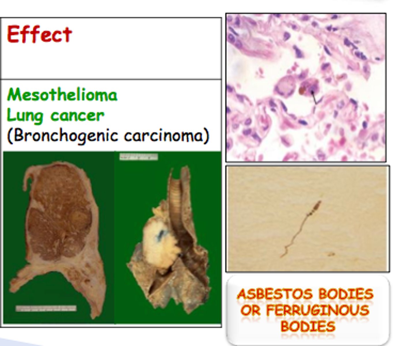 <p>a. Health effects</p><p>i. Accumulate in lungs after inhalation</p><p>ii. Chronic toxicity = high</p><p>1. Asbestosis, lung cancer, mesothelioma, and tumor.</p><p>2. Symptoms years after exposure</p><p>3. Effects depend on length, diameter and composition of fiber</p>