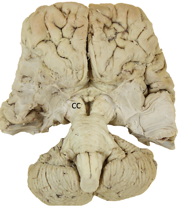 <p></p><p><strong>direct motor pathways</strong></p><ul><li><p>the crus cerebri is the continuation of the posterior limb of the ______</p><ul><li><p>the base of the midbrain</p></li></ul></li></ul><p></p>