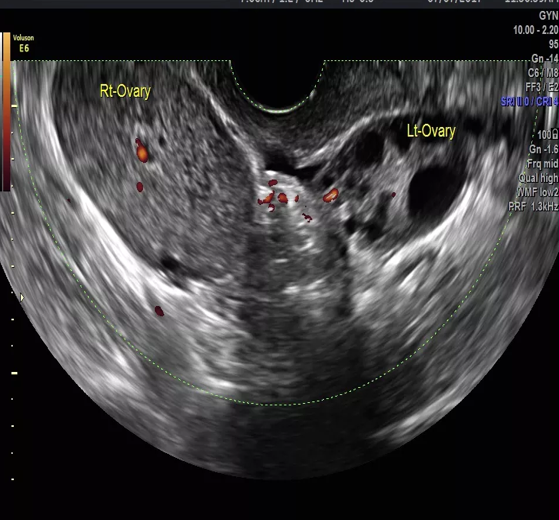<p>What are sonographic findings of ovarian torsion?</p>