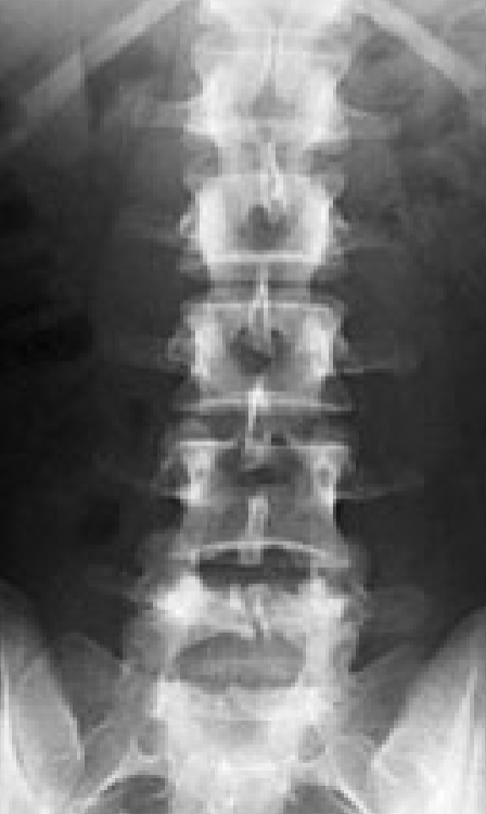 <p>Which part of the spine is this image of?</p>