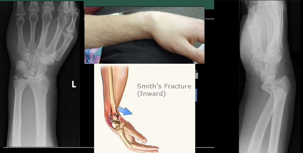 <p>Smith’s Fracture. FOOSH with flexed hand. In contrast to a Colles&apos; fracture, a Smith&apos;s fracture involves the distal radius bone breaking and the fractured fragment being displaced volarly (toward the palm of the hand). This leads to a deformity where the wrist and hand appear angulated and bent toward the palm side.</p>