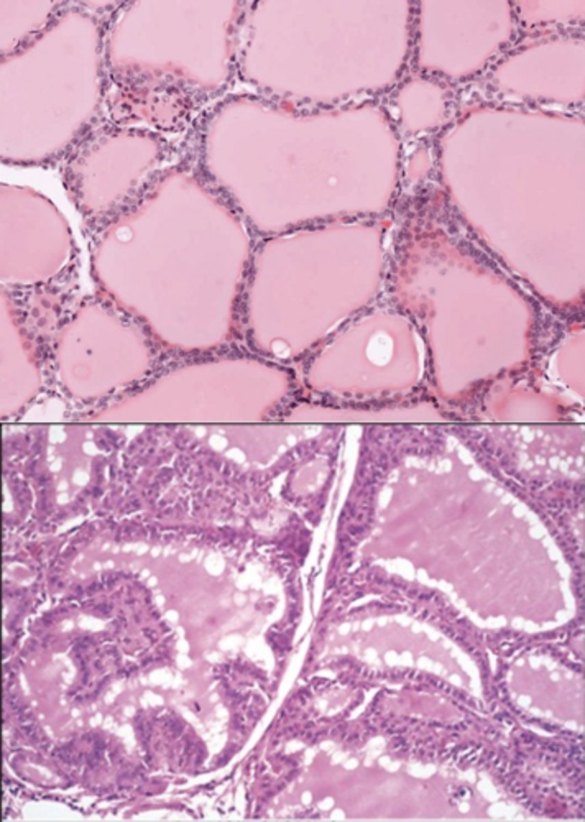 <p>A 40-year-old female patient presents heat intolerance, easy nervousness, difficulty sleeping. Her eyes are bulging as the picture below.</p><p>Her physical examination shows weight loss, increased heart rate. Her neck examination shows a soft, diffuse, nonnodular midline mass that is mobile on swallowing.</p><p>The histologic appearance of this organ on the neck under normal health condition would show as the picture on the top. The histologic examination of this patient shows as the picture on the bottom.</p><p>What is this organ?</p>