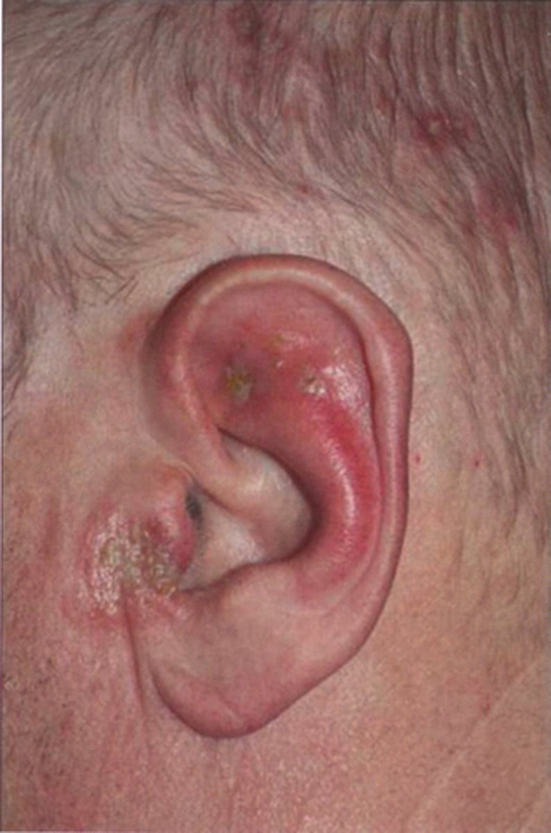 <p>ORAL ACICLOVIR + CORTICOSTEROIDS</p>