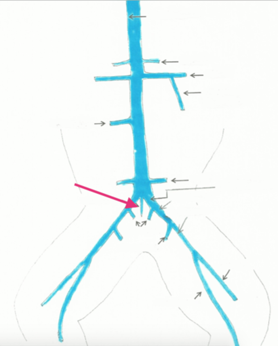 <p>drains into left common iliac vein</p>