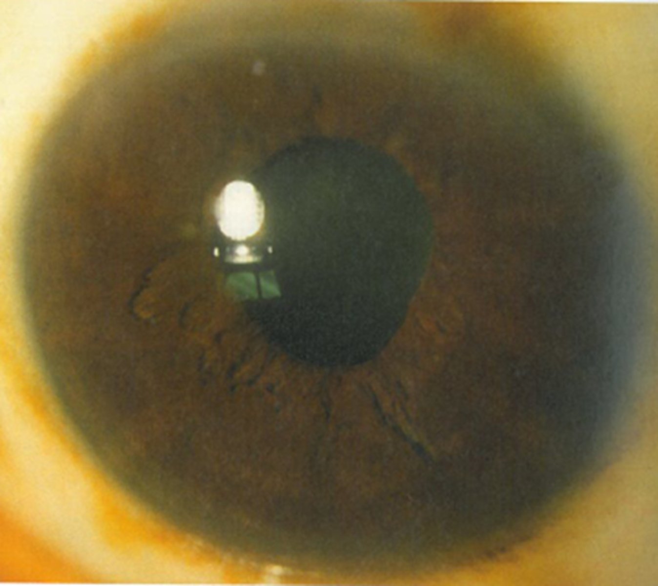 <p>usually when pt's already have a known systemic disease such as...</p><p>DM</p><p>syphillis</p><p>Sarcoid</p><p>dysautonomia</p><p>Charcot-marie-Tooth syndrome</p><p>Ross' syndrome</p><p>NOTE: all are rare!</p>