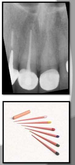 <p>Gutta percha - clay-like thermoplastic material used in root canal therapy to obliterate the pullp canals.&nbsp;</p><ul><li><p>appears radiopaque similar to base materials</p></li><li><p>less radiodense than metallic restorations.&nbsp;</p></li></ul><p></p>