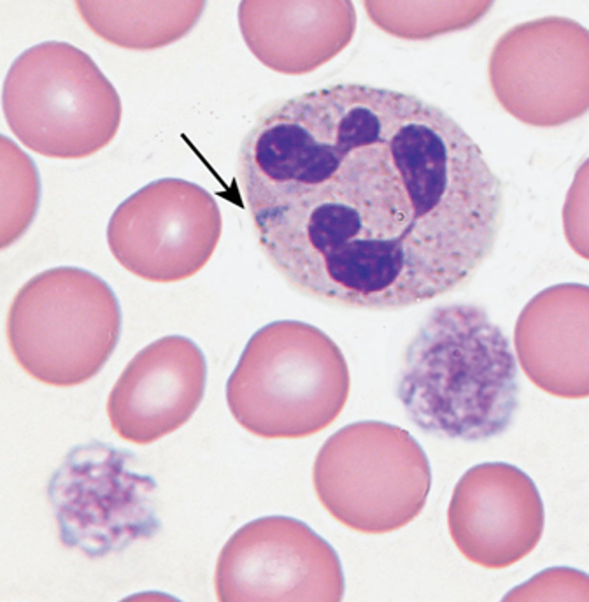 <p>- neutrophils have blue-staining inclusions that resemble Dohle bodies</p><p>- thrombocytopenia</p><p>- giant abnormal platelets</p>