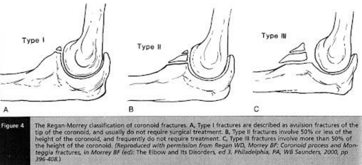 Regan-Morrey Classification of Coronoid Fractures