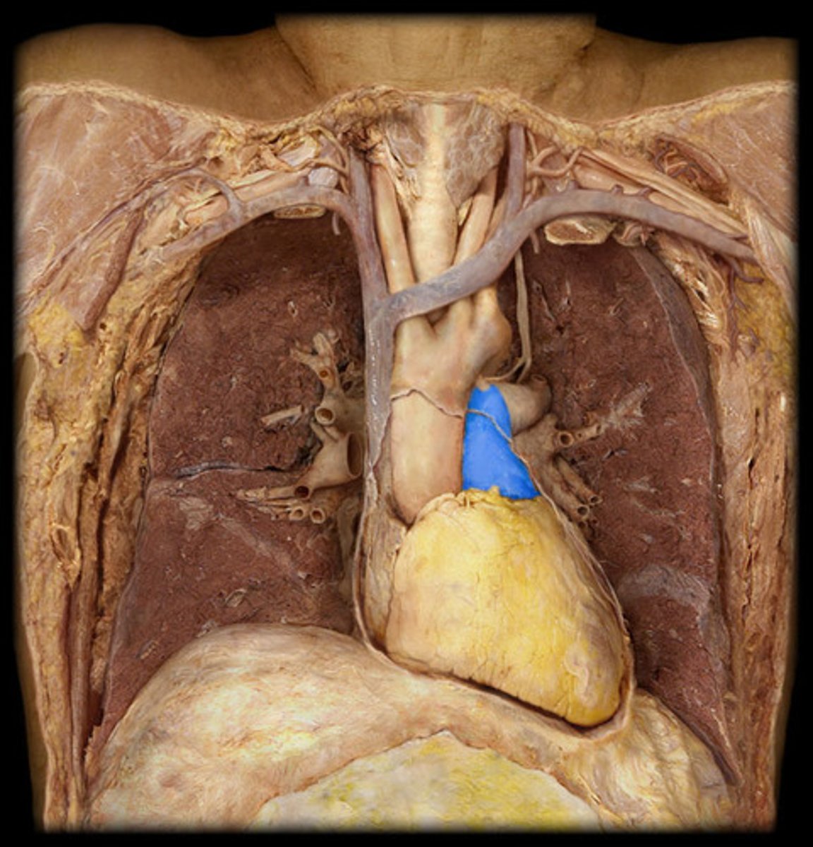 <p>carries blood from right ventricle to pulmonary arteries</p>