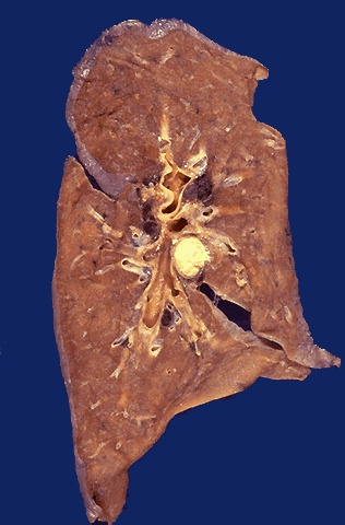 <ol><li><p>Grossly, a granuloma tends to be a ___ lesion</p></li><li><p>Location example of granuloma</p></li><li><p>What type of necrosis happening? due to?</p></li></ol><p></p>