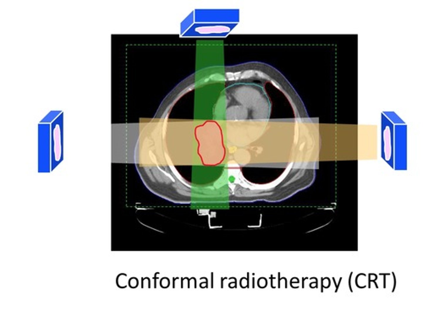 <p>allows the dosimetrist to plan and design beams that are coplanar and noncoplanar - tightly conforming to the target/tumor volume</p>