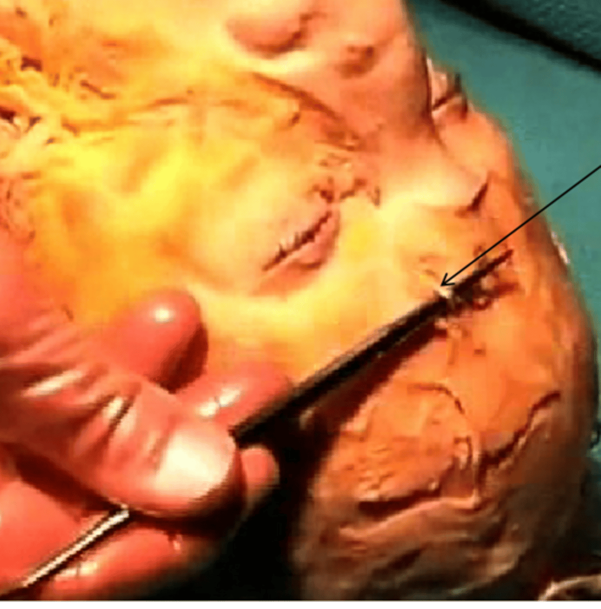 <p>supraorbital nerve on top of probe after locating supraorbital foramen or notch</p>