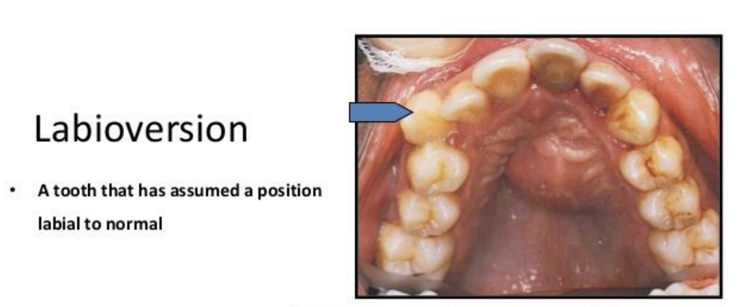<p>Malocclusion of the teeth where a tooth is out of alignment towards the labial/buccal direction </p>