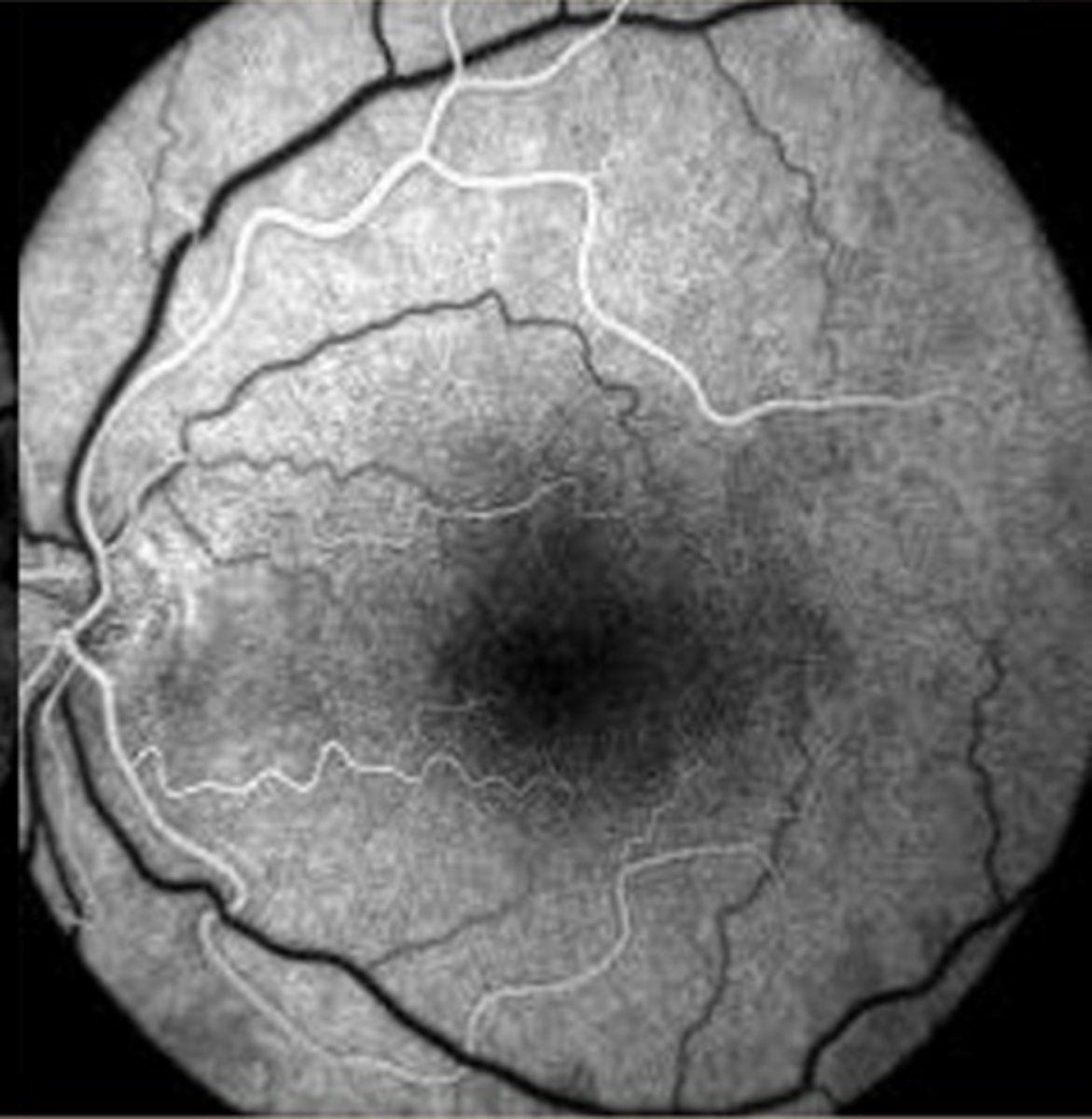 <p>12-15 sec</p><p>(1-3 sec after choroidal flush)</p>