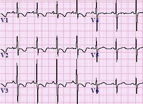 <p>RVH diagnosis:</p>