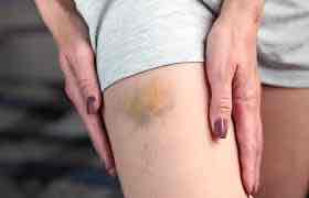 <p>Bruise </p>