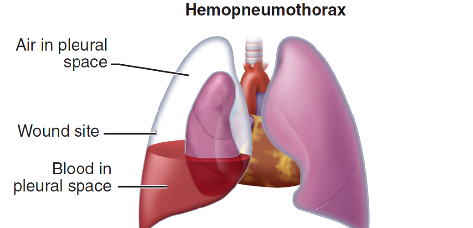 accumulation of blood and air in the pleural space of the chest 