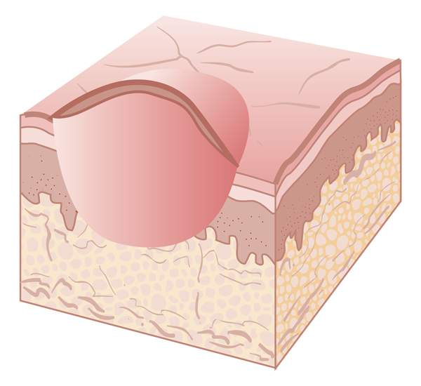 <p>solide elevation &lt; 0.5cm in diameter and has distinct borders</p>