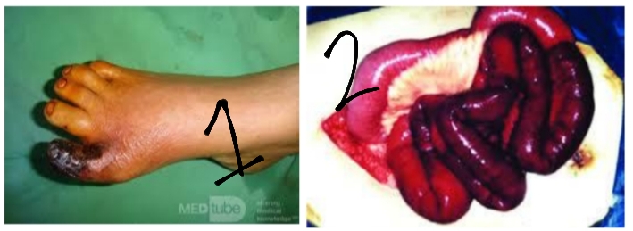 <p>What types of gangrene are shown?</p>