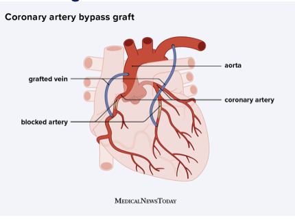 <p>open heart surgery where vessel removed from another part of body and grafted to either side of the blockage to divert blood flow&nbsp;</p>