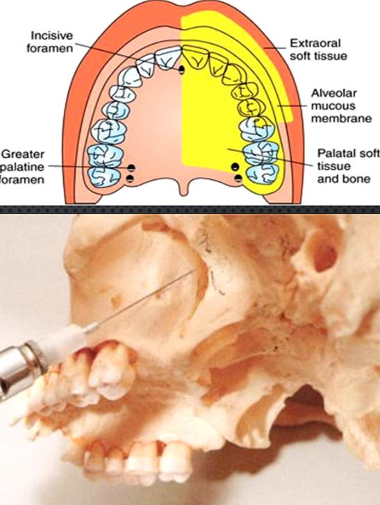 <ul><li><p>Area anesthetized: all palatal mucosa of the quadrant, pulpal for all but max molars (except MB cusp), all buccal mucosa except that of Max molars (except MB cusp) → <mark data-color="yellow" style="background-color: yellow; color: inherit;">ONLY BLOCK THAT CAN ANESTHETIZE MOST OF THE QUADRAT AT ONCE</mark></p></li><li><p>Procedure: same exact thing as PSA except insertion is 30mm</p></li><li><p>Onset of action:3-5 min</p></li><li><p>Complications: <mark data-color="red" style="background-color: red; color: inherit;">Highest risk of hematoma and intravascular injection of all blocks</mark>, not recommended for inexperienced clinicians</p></li><li><p>Amount of anesthetic: 1.8ml</p></li></ul><p></p>