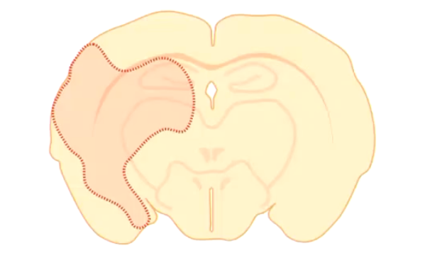 <p><strong>• Almost complete loss of one or both cerebral hemispheres which is replaced by CSF (=cerebral cavity)</strong></p><p>• It was initially well-formed but is destroyed.</p><p>• Almost complete absence of cerebral cortex, reduced to a thin layer.</p><p>• The adjacent skull may be abnormal too.</p>