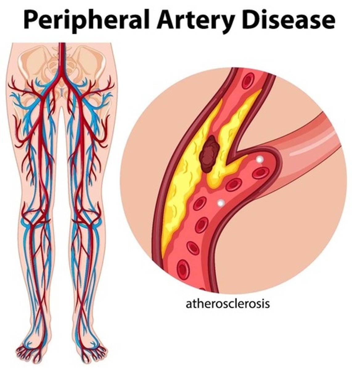 <p>Buildup of fats and cholesterol in arteries.</p>