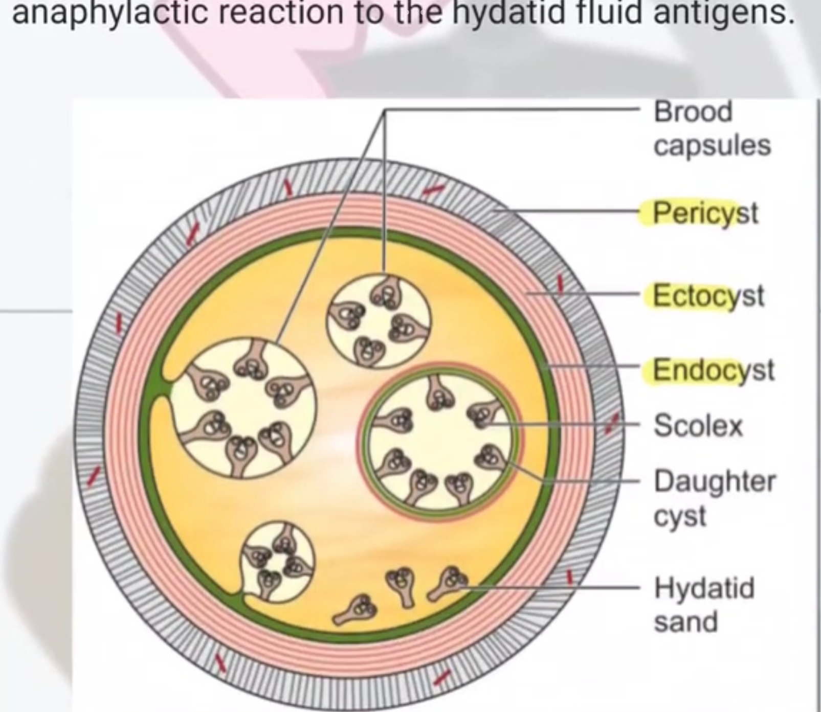 <p>Echinococcus granulosus hydatid cyst w protoscolices</p>