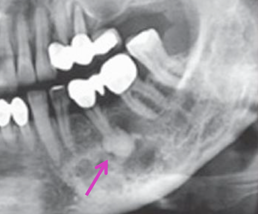 <p>90% occur in females, AA</p><p>Middle age</p>