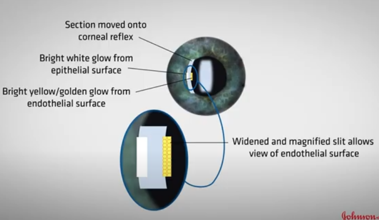 <p>illumination at 45 </p><p>microscope in straight ahead direction </p><p>&nbsp;Increase mag x16</p><p>Adjust slit width and brightness</p><p>Move corneal section onto the bright corneal reflex ( purkinje image)</p><p>reduce slitheight to the same size as corneal reflex  </p><p>now will be able to see a section of the endothelium and epithelium&nbsp;&nbsp;</p><p></p>
